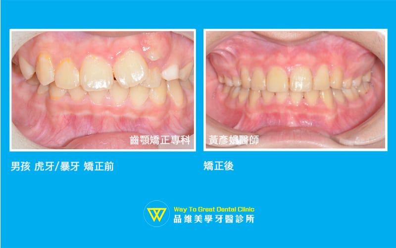13歲男孩虎牙暴牙-兒童牙齒矯正-口內照-台中牙齒矯正-推薦-品維美學牙醫