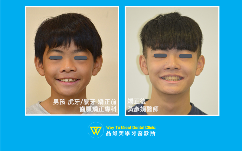 13歲男孩虎牙暴牙-兒童牙齒矯正-臉部照-台中牙齒矯正-推薦-品維美學牙醫
