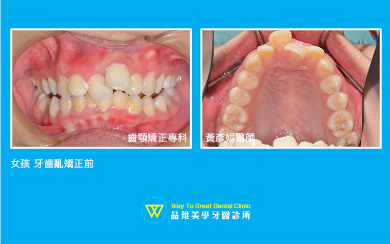 女孩牙齒亂矯正-before-兒童牙齒矯正-台中牙齒矯正-推薦-品維美學牙醫