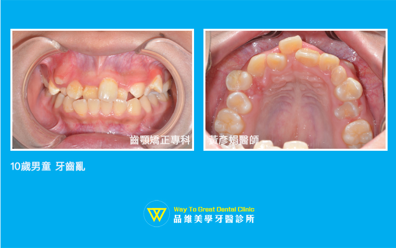牙齒亂-before-台中牙齒矯正-推薦-品維美學牙醫