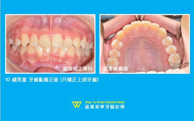 牙齒亂-青少年牙齒矯正-after-台中牙齒矯正-推薦-品維美學牙醫