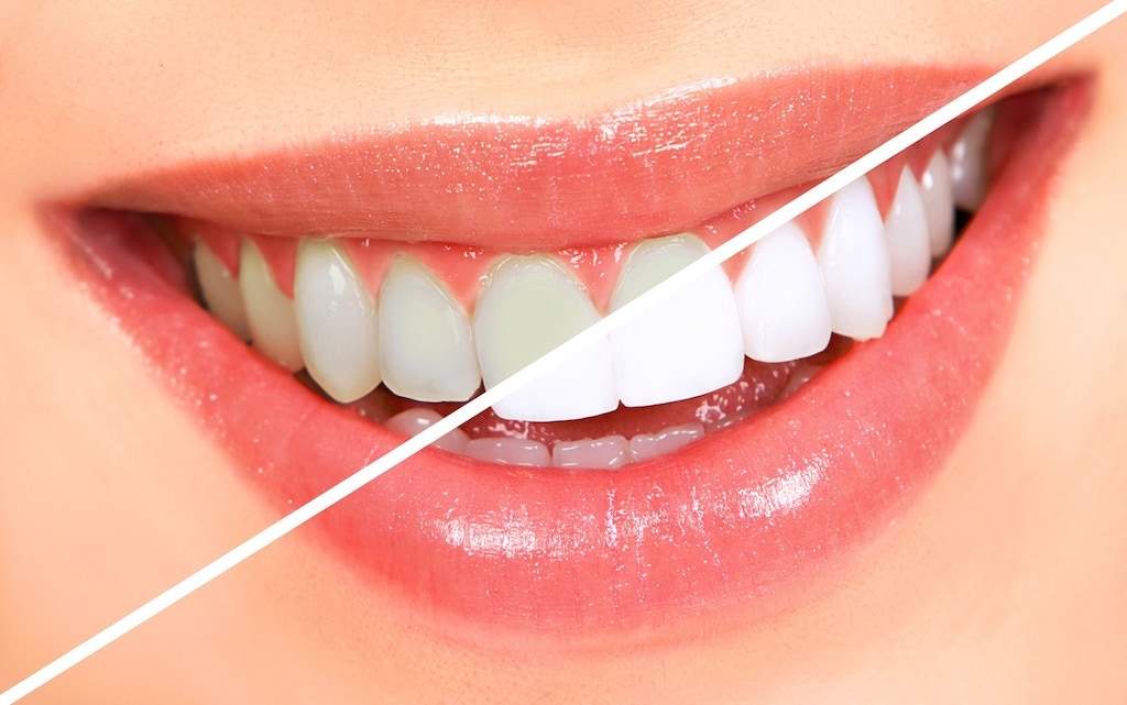牙齒美白-台中牙齒美白牙醫