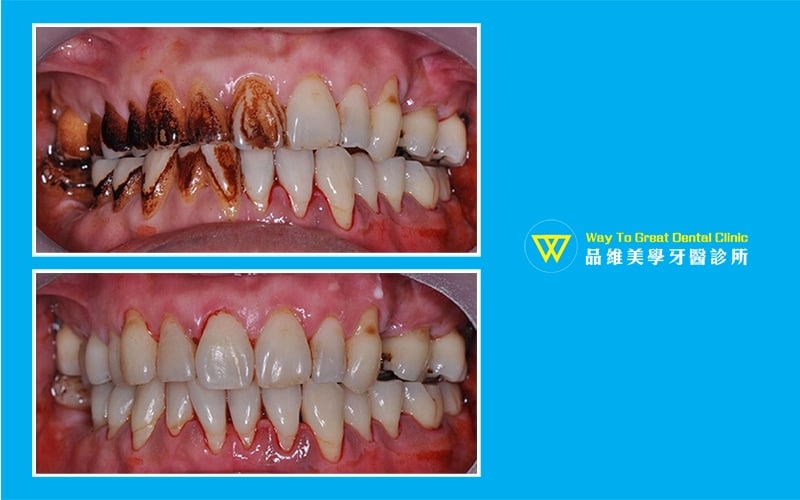 牙齒美白-噴砂美白-牙齒變色-推薦-台中北屯品維美學牙醫