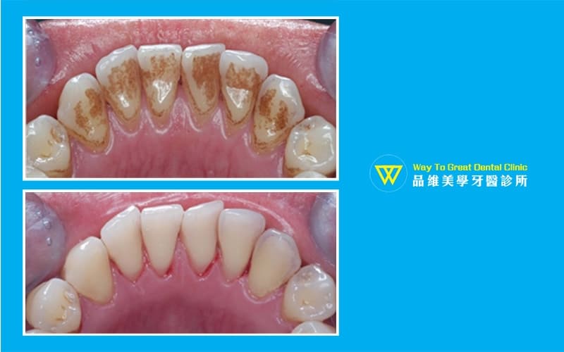 牙齒美白-噴砂美白-牙齒黃-牙內側變色-推薦-台中北屯品維美學牙醫