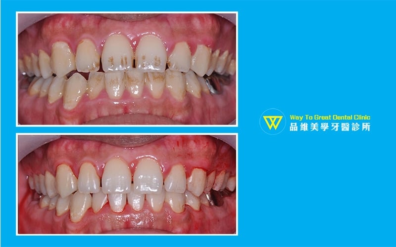 牙齒美白-噴砂美白-牙齒黃-牙齒變色-推薦-台中北屯品維美學牙醫