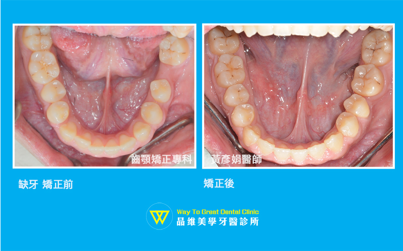缺牙-牙齒矯正-口內照-台中牙齒矯正-推薦-品維美學牙醫