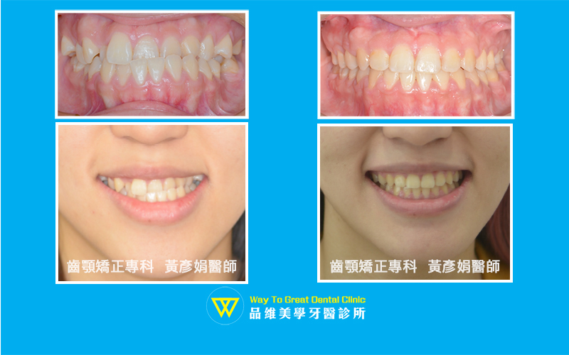 缺牙錯咬-牙齒矯正-臉部-台中牙齒矯正-推薦-品維美學牙醫