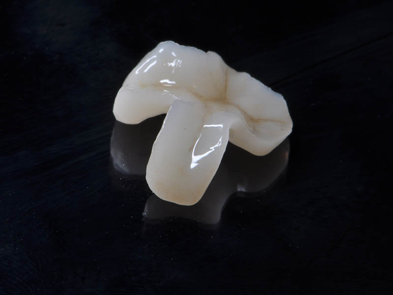 假牙-假牙贗復-陶瓷嵌體-3D齒雕-全瓷嵌體-台中-品維美學牙醫