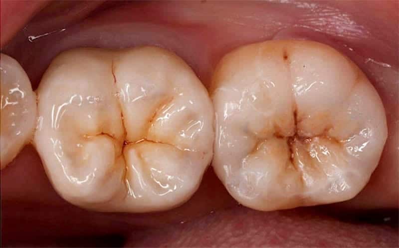 蛀牙-移除銀粉-3D齒雕-全瓷嵌體-台中-品維美學牙醫