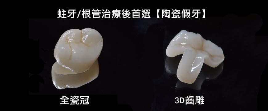 蛀牙-抽神經-根管治療牙套-3D齒雕-全瓷冠-推薦-台中-品維美學牙醫