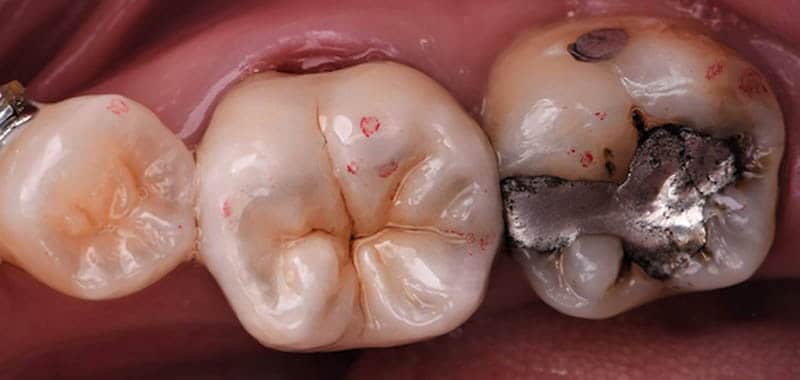 蛀牙-蛀牙補牙-銀粉補牙-台中-品維美學牙醫
