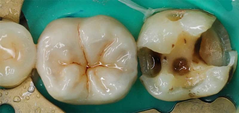 蛀牙-蛀牙補牙-銀粉補牙-移除蛀牙銀粉後牙齒缺損範圍-台中-品維美學牙醫