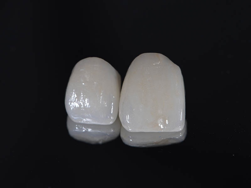 陶瓷貼片-全瓷貼片-黏著式-假牙贗復-BPR-台中-品維美學牙醫