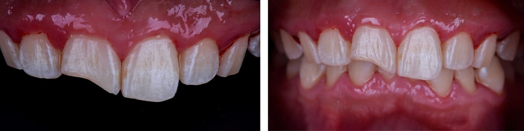 台中-一日假牙-步驟一-全口檢查分析-門牙缺角案例