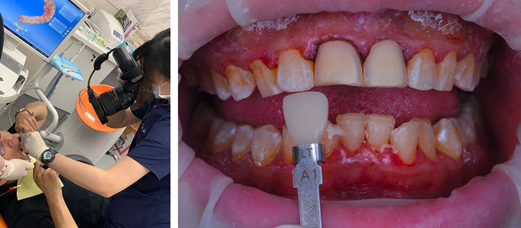 台中-一日假牙-步驟三-醫師-數位牙技師-患者-三方討論假牙外型-比色拍照