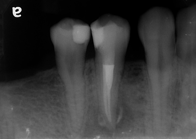 顯微根管治療案例-斷離器械處理-治療完成-雙根管-小臼齒-品維美學牙醫-台中