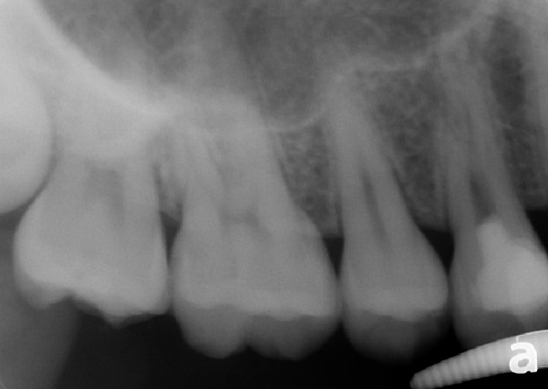 顯微根管治療案例-額外根管之處理-治療前-品維美學牙醫-台中