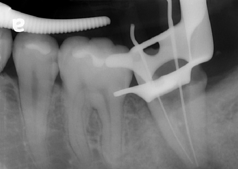 顯微根管治療案例-治療中-牙隨腔-根管穿孔-品維美學牙醫-台中