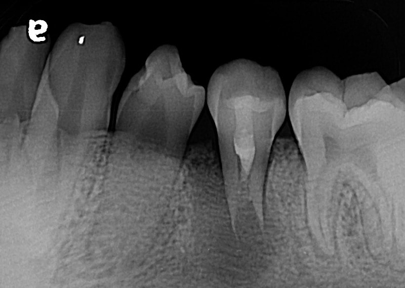 顯微根管治療案例-治療前-品維美學牙醫-台中
