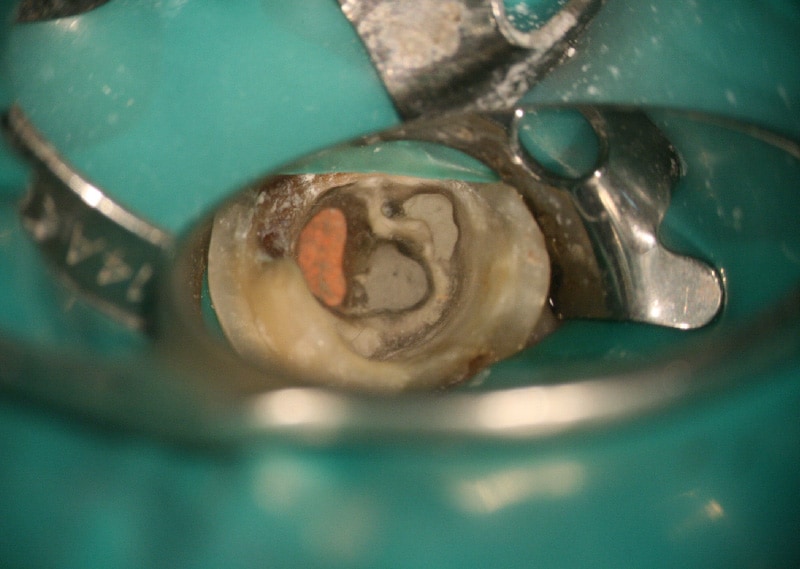 顯微根管治療案例-牙隨腔-根管穿孔-顯微鏡下-修補-根管穿孔處-品維美學牙醫-台中