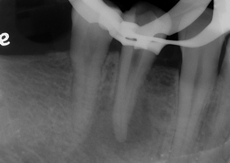 顯微根管治療案例-斷離器械處理-根管內器械已取出-品維美學牙醫-台中