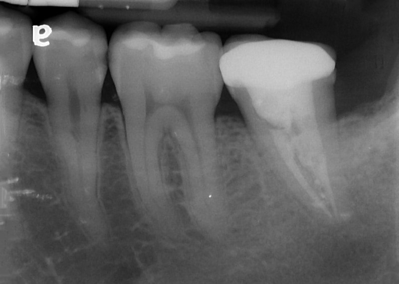 顯微根管治療案例-牙隨腔-根管穿孔-治療完成-下顎-臼齒-C型根管-品維美學牙醫-台中