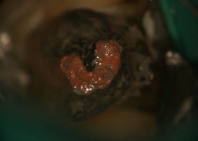 顯微根管治療案例-複雜性根管處理-下顎-大臼齒-顯微鏡下-C型根管-品維美學牙醫-台中