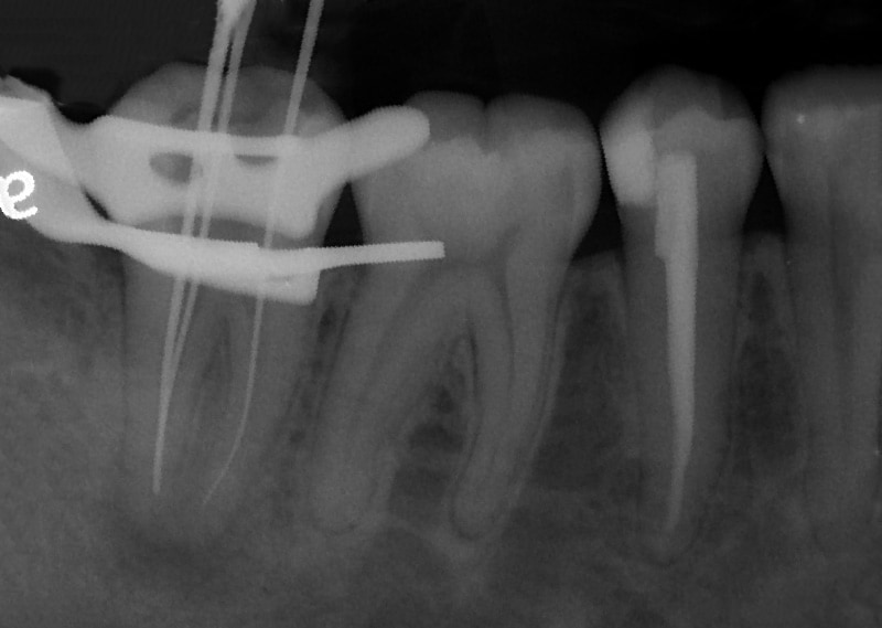 顯微根管治療案例-複雜性根管處理-治療中-下顎-大臼齒-C型根管-品維美學牙醫-台中