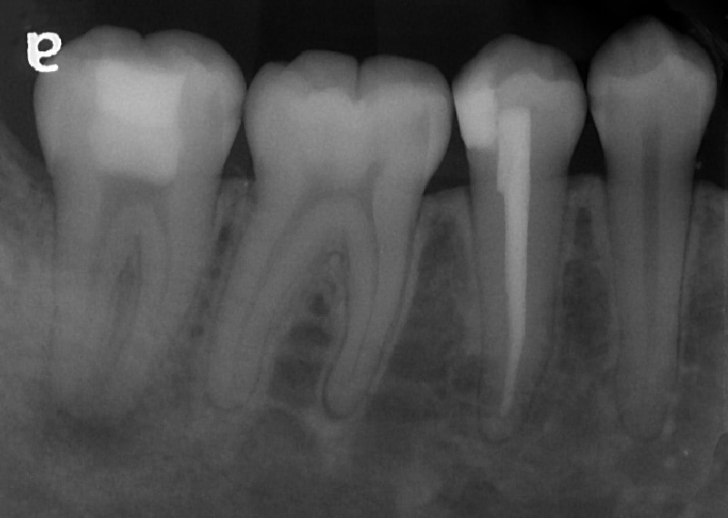 顯微根管治療案例-複雜性根管處理-治療前-下顎-大臼齒-C型根管-品維美學牙醫-台中