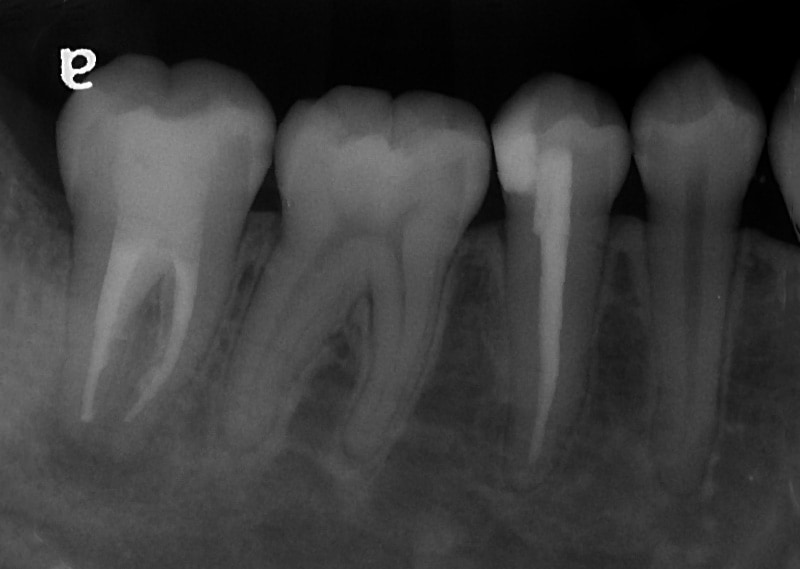顯微根管治療案例-複雜性根管處理-治療完成-下顎-大臼齒-C型根管-品維美學牙醫-台中