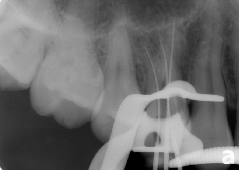 顯微根管治療案例-額外根管之處理-治療中-品維美學牙醫-台中