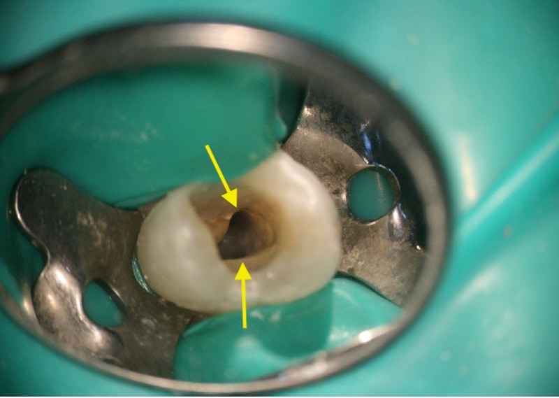 顯微根管治療案例-額外根管處理-顯微鏡下可見額外根管-品維美學牙醫-台中