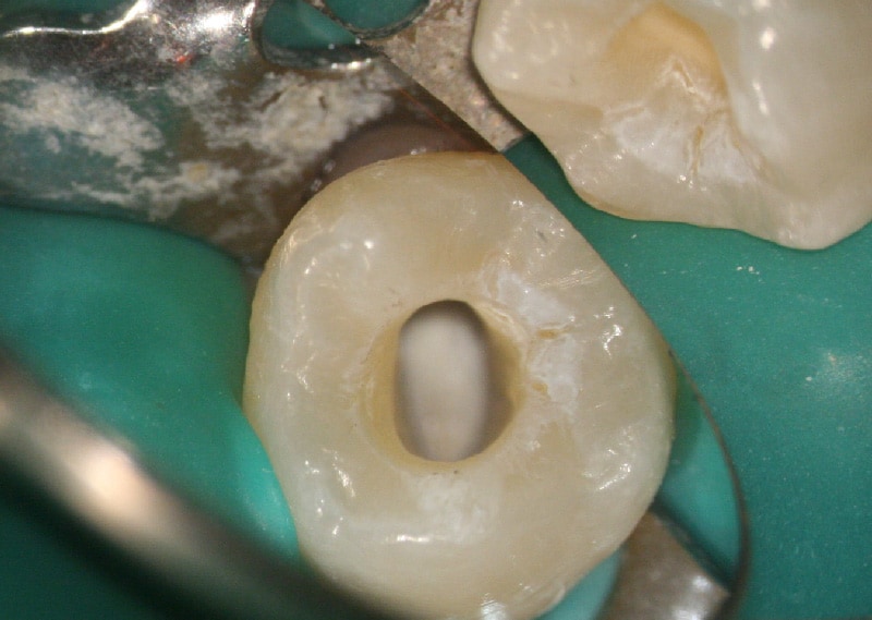 顯微根管治療案例-顯微鏡下-根尖修補完成-品維美學牙醫-台中