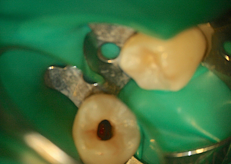 顯微根管治療案例-顯微鏡下-根尖開口未閉合-品維美學牙醫-台中