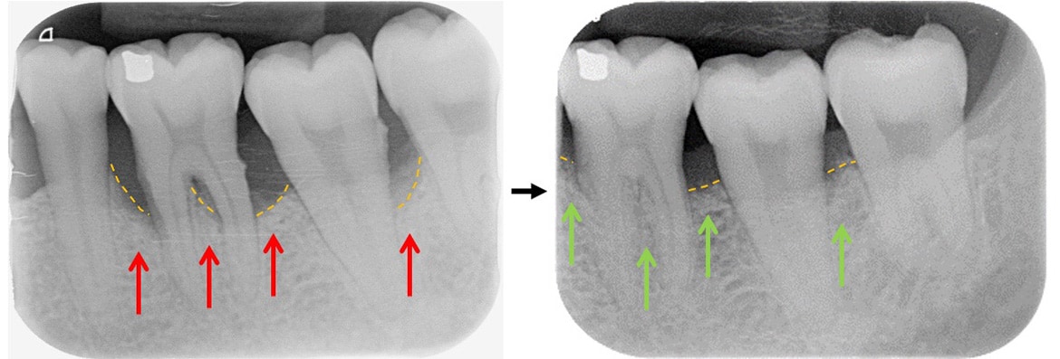 嚴重牙周病治療-補骨再生手術-案例1-手術前後X光片-李晉成醫師-台中