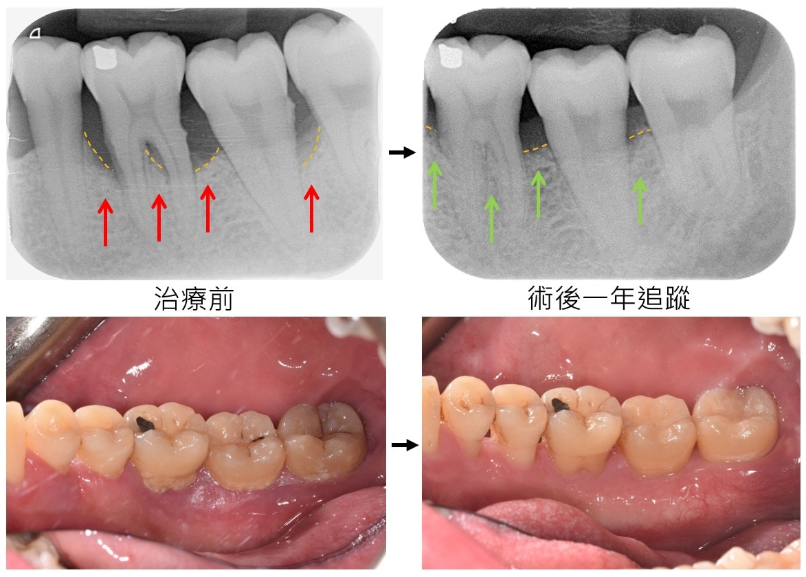 嚴重牙周病治療-補骨再生手術-案例1-手術前後對比-李晉成醫師-台中