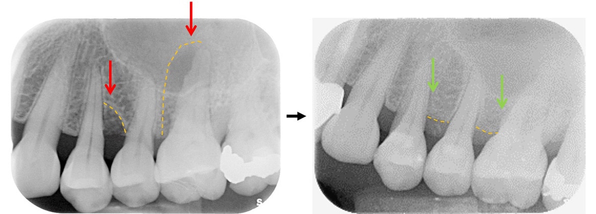 嚴重牙周病治療-補骨再生手術-案例2-手術前後X光片-李晉成醫師-台中