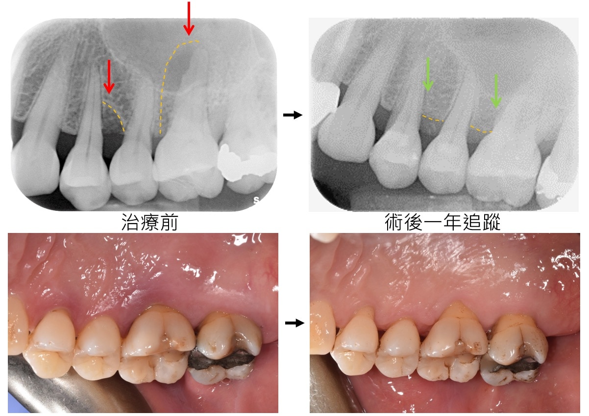 嚴重牙周病治療-補骨再生手術-案例2-手術前後對比-李晉成醫師-台中
