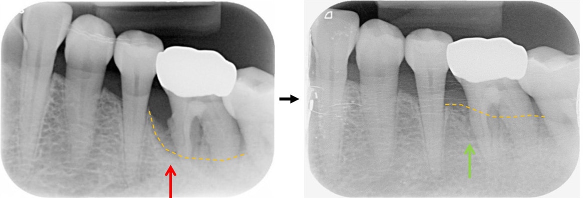 嚴重牙周病治療-補骨再生手術-案例3-手術前後X光片-李晉成醫師-台中