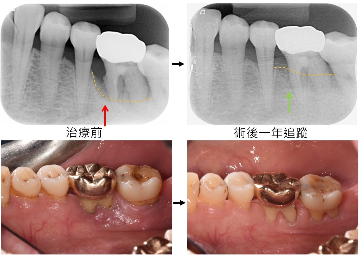 嚴重牙周病治療-補骨再生手術-案例3-手術前後對比-李晉成醫師-台中