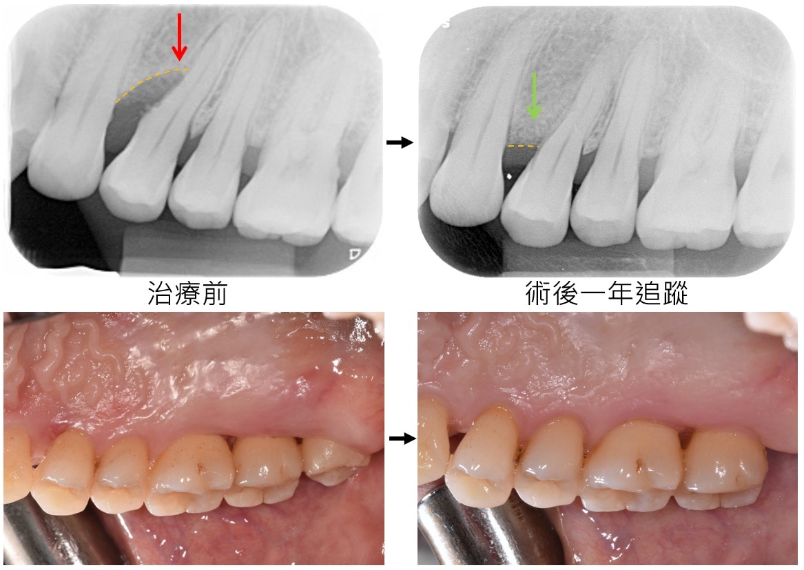 嚴重牙周病治療-補骨再生手術-案例4-手術前後對比-李晉成醫師-台中