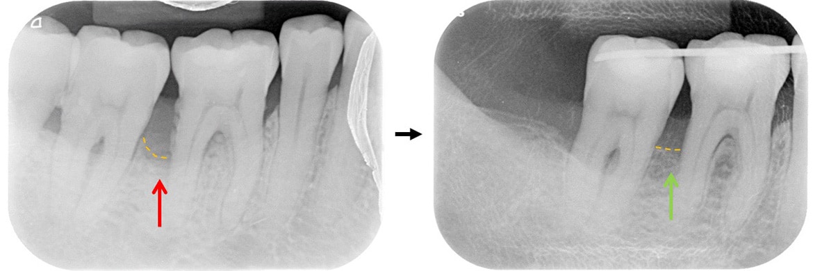 嚴重牙周病治療-補骨再生手術-案例5-手術前後X光片-李晉成醫師-台中