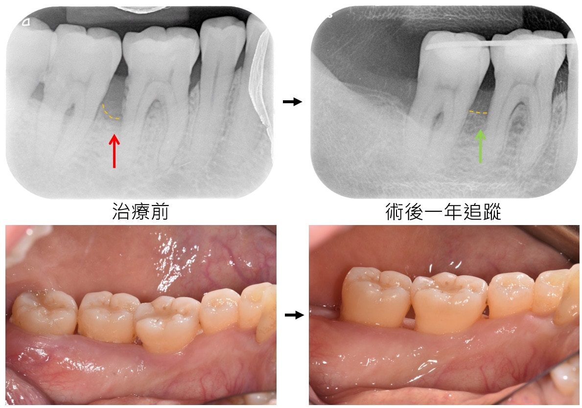 嚴重牙周病治療-補骨再生手術-案例5-手術前後對比-李晉成醫師-台中