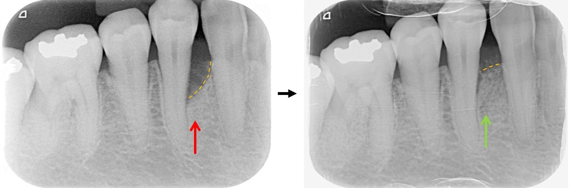 嚴重牙周病治療-補骨再生手術-案例6-手術前後X光片-李晉成醫師-台中