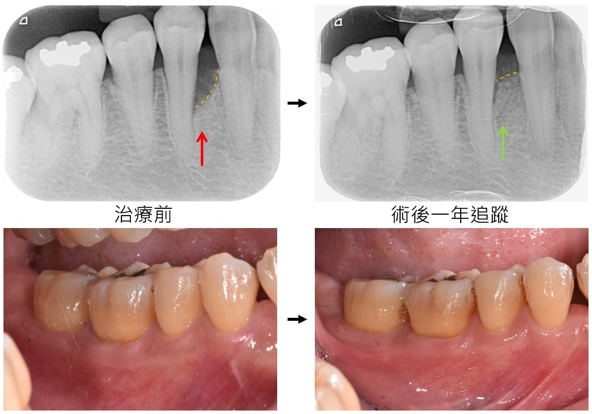 嚴重牙周病治療-補骨再生手術-案例6-手術前後對比-李晉成醫師-台中