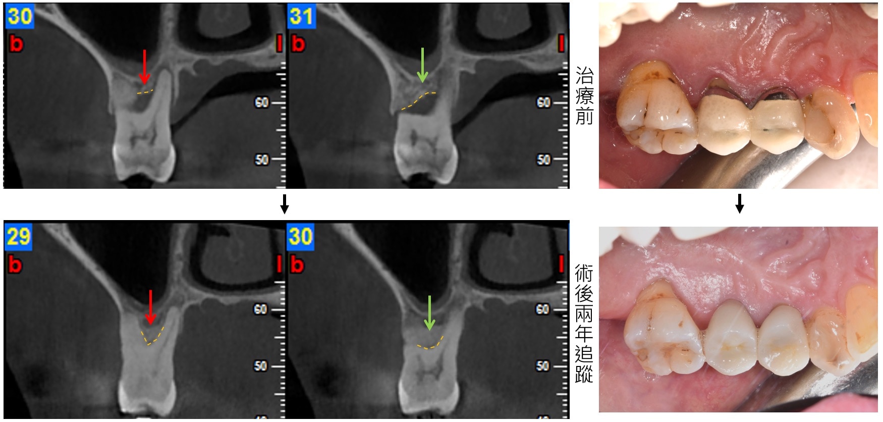 嚴重牙周病治療-補骨再生手術-案例7-手術前後對比-李晉成醫師-台中