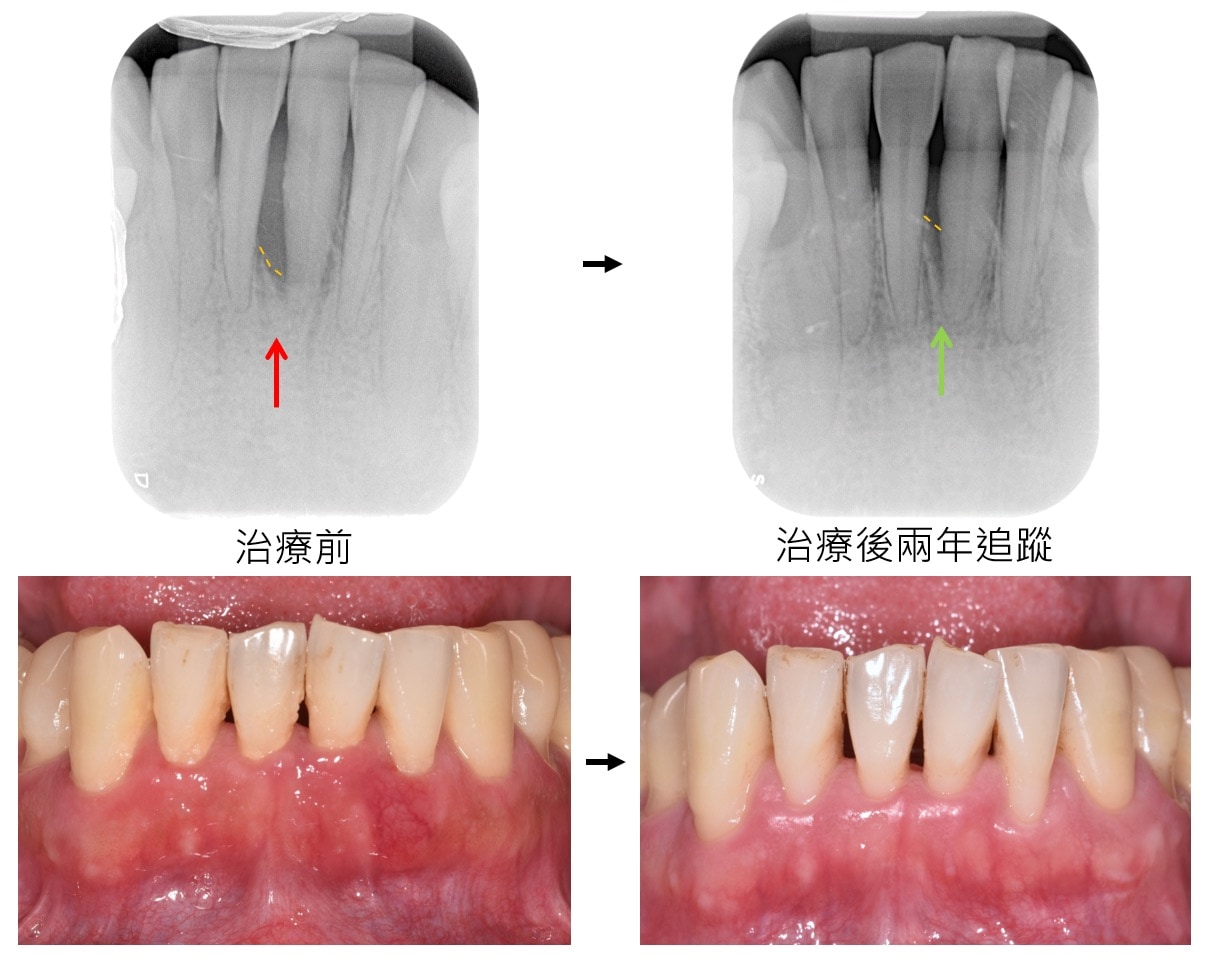 嚴重牙周病治療-雷射牙周治療-案例1-手術前後對比-李晉成醫師-台中