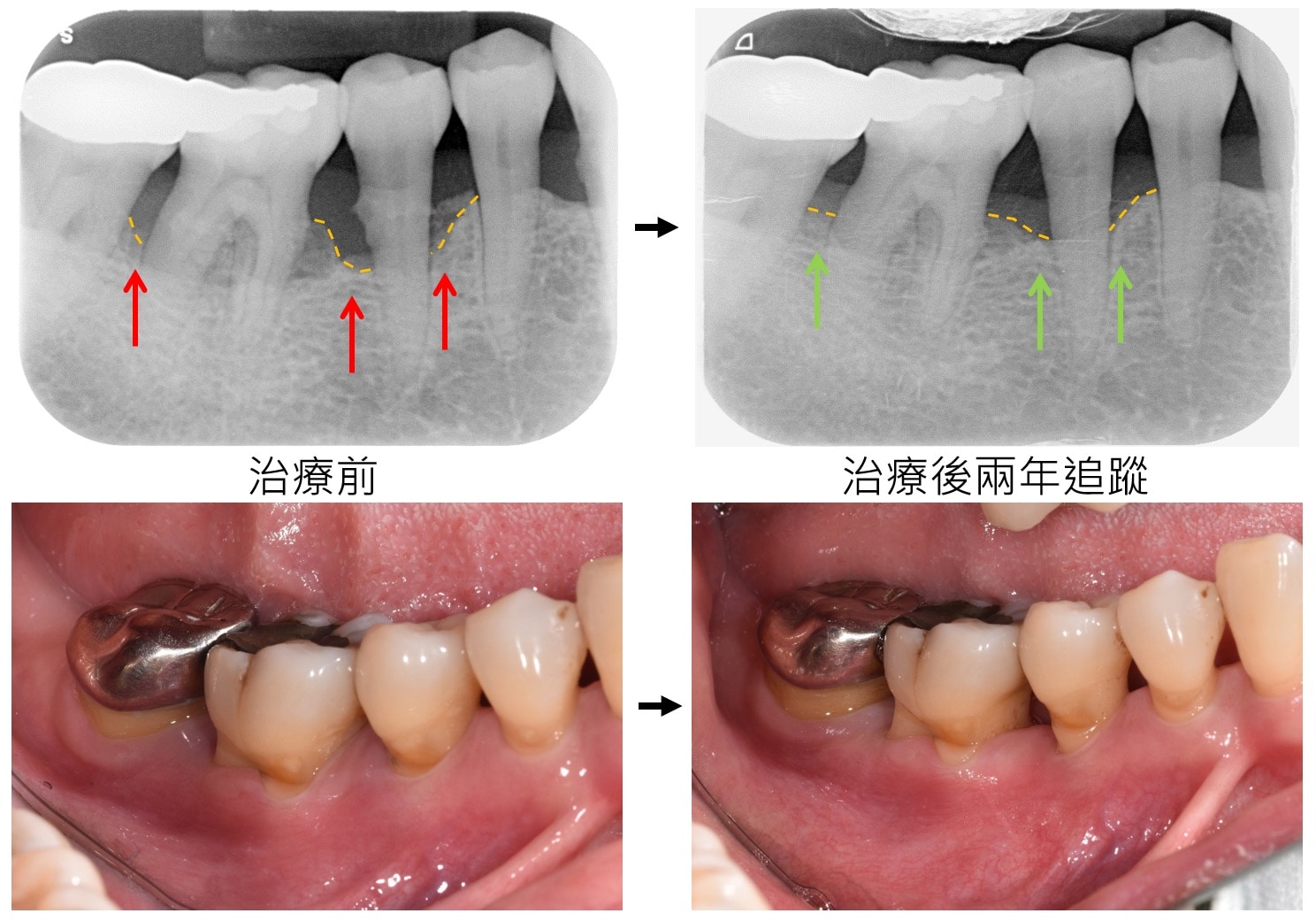 嚴重牙周病治療-雷射牙周治療-案例2-手術前後對比-李晉成醫師-台中