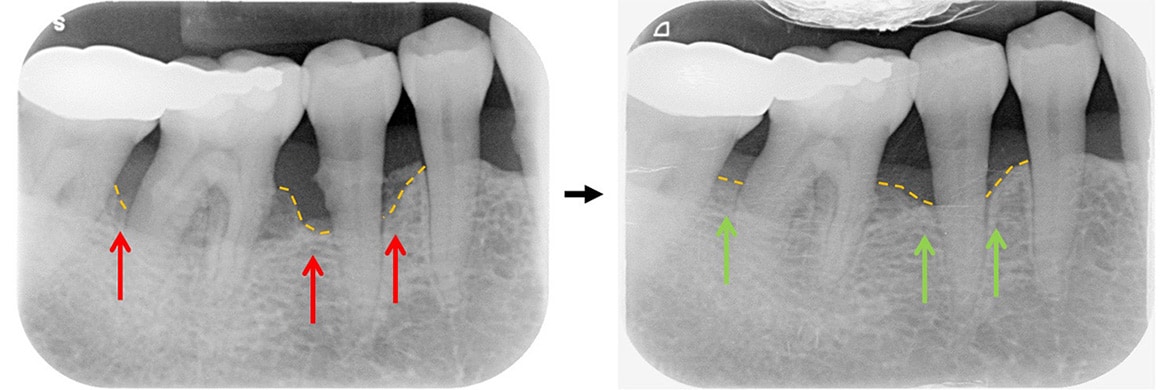 嚴重牙周病治療-雷射牙周治療-案例2-治療前後X光片-李晉成醫師-台中