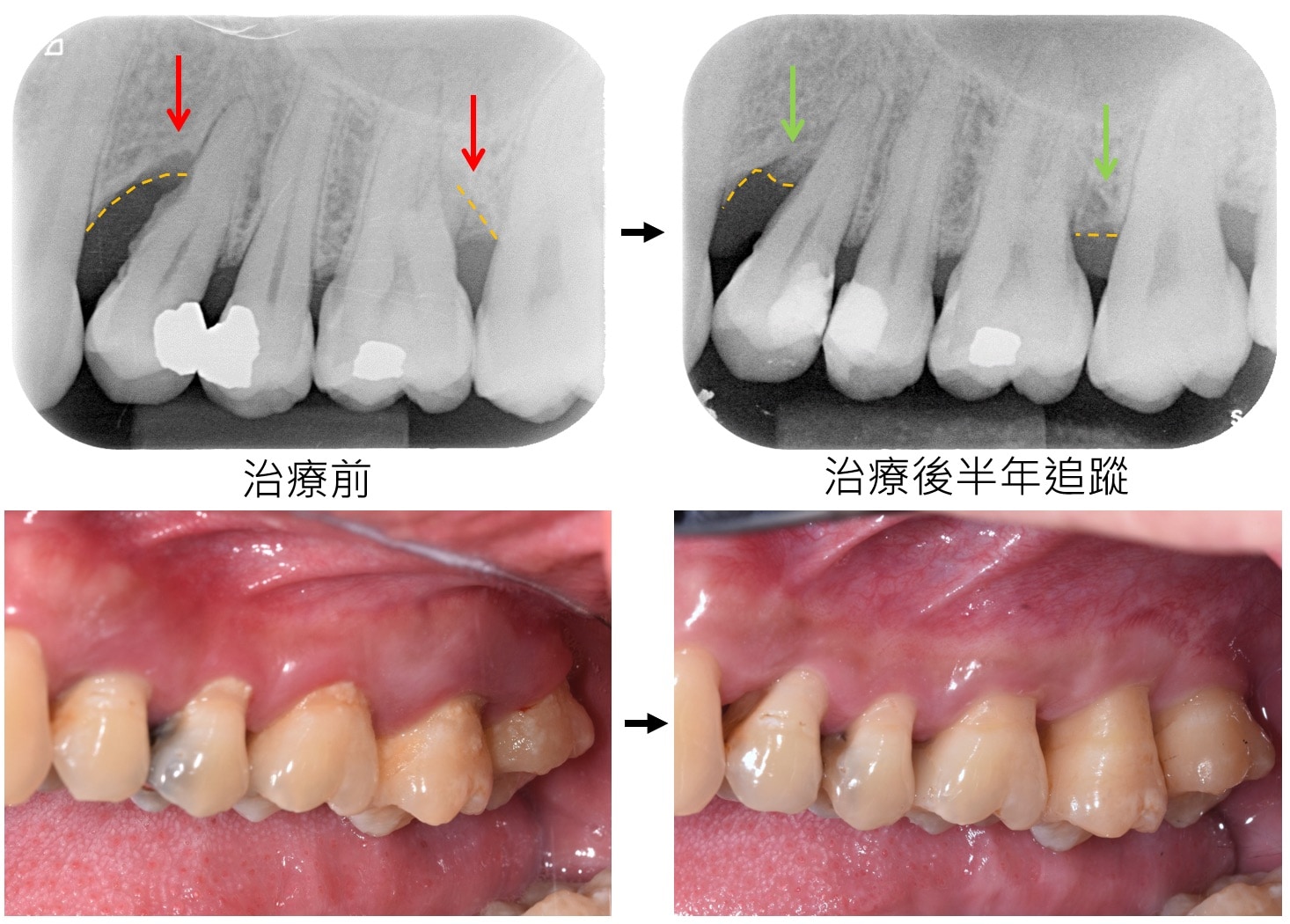 嚴重牙周病治療-雷射牙周治療-案例3-手術前後對比-李晉成醫師-台中